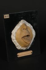 Plaques syphilitiques de la langue. Femme âgée de 49 ans, domestique