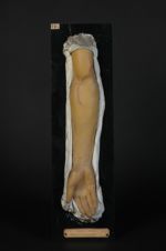 Psoriasis gyrata et circinata. Homme âgé de 34 ans, cultivateur