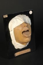 Glossite syphilitique scléro-gommeuse (Inv. 1922). Homme âgé de 42 ans, garçon de magasin