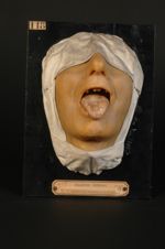 Leucoplasie linguale. Homme âgé de 69 ans, cordonnier