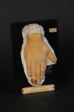 Onychose, lésion héréditaire non syphilitique des ongles. Homme âgé de 21 ans, maçon (V. le n° 364,  [...]