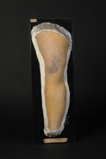 Pityriasis rubra pilaire (Inv. 1889). Femme âgée de 31 ans domestique