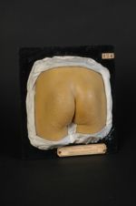 Xanthome (Inv. 1889). Homme âgé de 16 ans, employé (V. le n° 123, main du même malade). Vitiligoïdea [...]