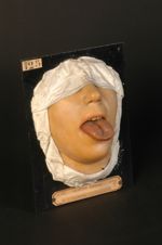 Gomme syphilitique de la langue. Femme âgée de 28 ans, confectionneuse