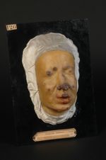 Lèpre tuberculeuse. Homme âgé de 33 ans, voyageur de commerce. Pays habité : l'île Maurice