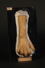 Lèpre tuberculeuse. Homme âgé de 33 ans, voyageur de commerce. Pays habité : l'île Maurice