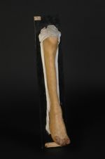 Lèpre tuberculeuse. Homme âgé de 33 ans, voyageur de commerce. Pays habité : l'île Maurice