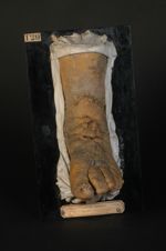 Éléphantiasis de la jambe (lnv. 1922). Homme âgé de 51 ans, charpentier. Pachydermie papillomateuse