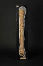 Syphilide pustulo-crustacée, syphilis maligne précoce ; infection datant de 13 mois. Homme âgé de 32 [...]