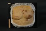 Cancer des deux mamelles avec généralisation, sous la forme nodulaire, à une partie de la peau du tr [...]