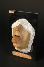 Syphilide ulcéreuse tertiaire de la langue. Homme âgé de 47 ans, homme de peine (V. le n° 179, même  [...]