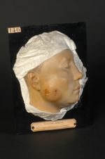 Périostose gommeuse syphilitique de la joue. Femme âgée de 36 ans, ferblantière