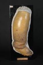 Éléphantiasis des Arabes. Homme âgé de 50 ans, négociant