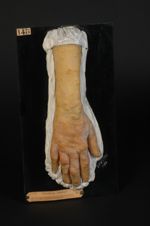 Lèpre tuberculeuse. Homme âgé de 26 ans, ferblantier