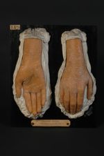 Eczéma rubrum des mains