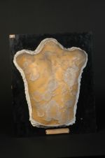 Psoriasis gyrata, circinata : lepra vulgaris. Homme âgé de 23 ans