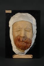 Epithéliome spino-cellulaire des lèvres et du menton (lnv. 1922)