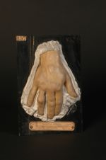 Tuberculose verruqueuse de la peau (lnv. 1922) et tuberculose osseuse de l'annulaire, avec fistule.  [...]