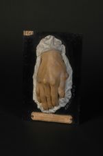 Tuberculose verruqueuse de la peau (lnv. 1922). Homme âgé de 34 ans, plisseur de soie. Scrofulide ve [...]