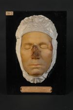 Epithéliomes du nez et de la région temporale sur kératose sénile (lnv. 1922). Homme âgé de 48 ans,  [...]