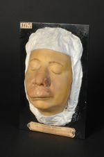 Syphilide tuberculo-gommeuse, avec hypertrophie de la lèvre supérieure (labialite syphilitique terti [...]