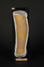 Psoriasis pityriasiforme de la jambe. Homme âgé de 24 ans, gardien de la paix