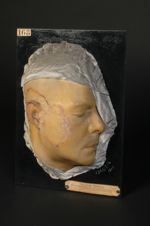 Lupus érythémateux (Inv. 1839) de la joue et de l'oreille. Cicatrisation et atrophie de la partie ce [...]