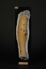 Syphilide papuleuse hémorragique. Homme âgé de 46 ans, lithographe