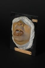 Ulcération de la langue de nature indéterminée ; leucoplasie secondaire. Homme âgé de 48 ans ancien  [...]