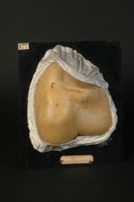 Macules consécutives à des papules syphilitiques circinées