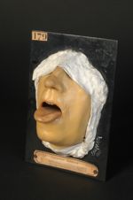 Syphilide ulcéreuse tertiaire de la langue, après traitement (V. le  n° 137, même malade avant trait [...]