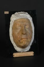 Syphilide papulo-crustacée, forme circinée, de la face (Inv. 1889). Syphilide circinée folliculaire  [...]