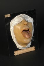 Gomme syphilitique de la langue