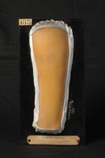 Trichophytie (Inv. 1889) de l'avant-bras. Femme âgée de 69 ans, brunisseuse