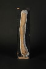 Lymphangite gommeuse tuberculeuse du membre supérieur, consécutive à une tuberculose verruqueuse de  [...]