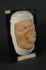 Acné hypertrophique du nez (Guérin). Syn. Rhinophyma, variété éléphantiasique (Inv. 1889). (Moulage  [...]