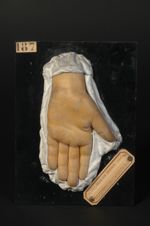 Naevus verruqueux avec ébauche de systématisation (Inv. 1922). Homme âgé de 16 ans, gantier. Kératod [...]