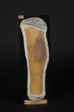 Lichen corné (Inv. 1922) de la jambe. Homme âgé de 46 ans, marchand de vin