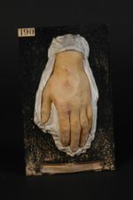 Erythème polymorphe à forme d'hydroa (Inv. 1922). Erythème multiforme (Inv. 1889). Hydroa, herpès ir [...]