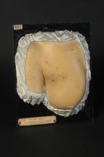 Syphilides folliculaires groupées autour de syphilides papuleuses lenticulaires (Inv. 1922). Femme â [...]