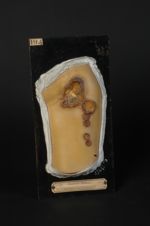 Chancres simples phagédéniques, chancres mous