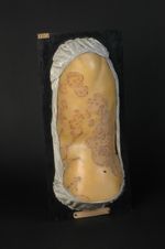 Syphilide tuberculo-crustacée serpigineuse. Homme âgé de 50 ans, employé