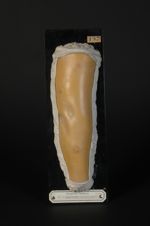 Éruption indéterminée du membre supérieur chez une femme diabétique