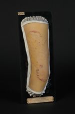 Lupus tuberculo-crustacé végétant (Inv. 1889) de la cuisse et du genou. Homme âgé de 16 ans, domesti [...]