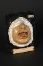 Scorbut, lésions des gencives