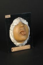 Gomme syphilitique ulcérée de la langue. Femme âgé de 71 ans, sans  profession (moulage décoloré, In [...]