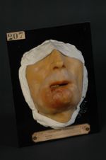 Épithéliome de la lèvre inférieure et du menton (V. le n° 212 [STLCGE00212], même malade après opéra [...]