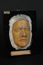 Syphilide papulo-squameuse de la face