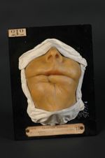 Épithéliome de la lèvre inférieure et du menton après opération (V. le n° 207 [STLCGE00207], même ma [...]