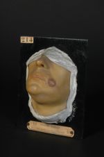 Chancre syphilitique de la joue. Homme âgé de 22 ans, serrurier